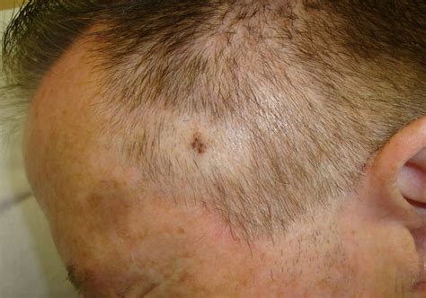 pictures of melanoma skin cancer on scalp
